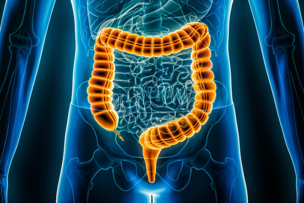 colon cancer
